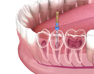 dent1