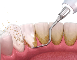 dent1