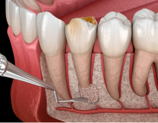 dent1