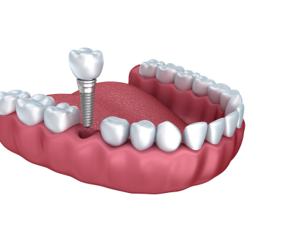 dent1