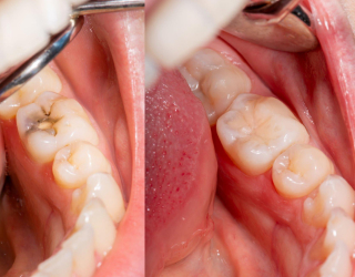 dent1