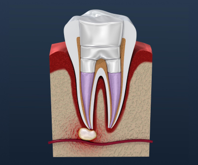 dent1