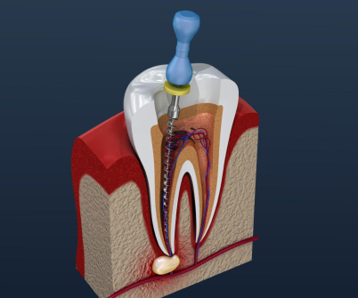 dent1