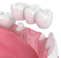 dent1