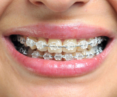dent1