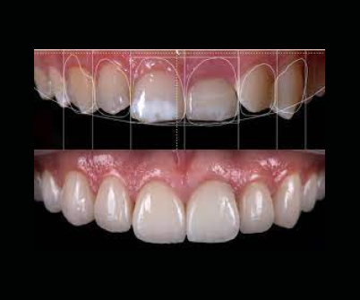dent1