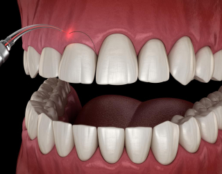 dent1