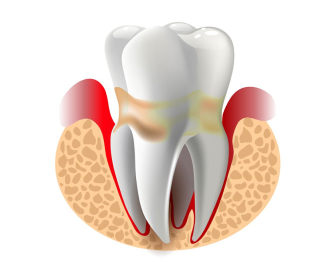dent1
