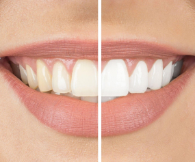 dent1