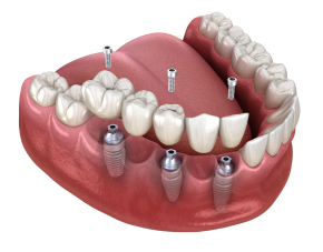 dent1