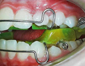 dent1